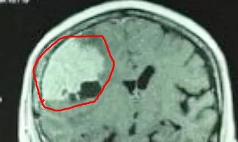 Đau đầu kéo dài vì khối u màng não 'khổng lồ'