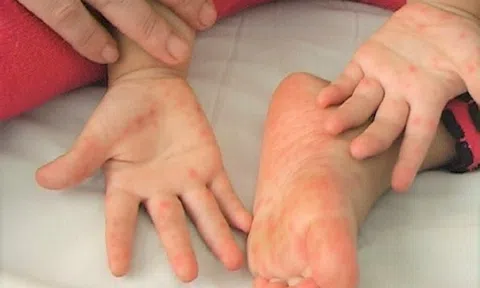 Một cháu bé tử vong vì bệnh tay chân miệng